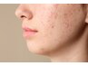 【お顔プロセルセラピーズ】肌荒れによる凹凸・毛穴の開きの改善☆￥35,000