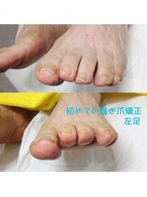ドクターネイル爪革命 長野店/【巻き爪ケア】ネイル/フット