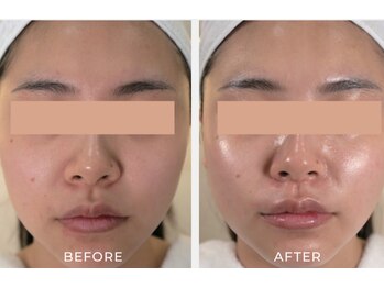 デラッセ サロン ギンザ 藤枝店(Delasser salon GINZA)/韓国iLLONうるツヤ水光肌