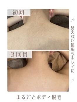 アリュール(ALLURE)/【脱毛の施術効果】