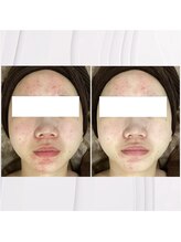 レイジュ(reiju)/ホワイトスノーピール