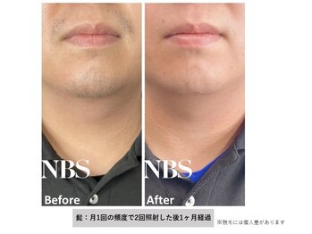 ヴァンカウンシル 豊橋店(VANCOUNCIL)/メンズ脱毛