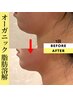 箇所当日相談★レモンボトル優良店!薄めなし!半永久脂肪分解★1箇所20分¥8800