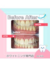 エクシアホワイトニング 札幌中島公園店/BeforeAfter［ホワイトニング］ 