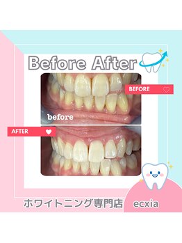 エクシアホワイトニング 札幌中島公園店/BeforeAfter［ホワイトニング］ 