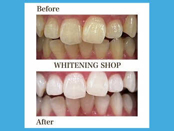 ホワイトニングショップ 福岡春日店/圧倒的なビフォーアフター