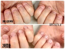 モアナ 池袋(MOANA)/人工爪深爪改善