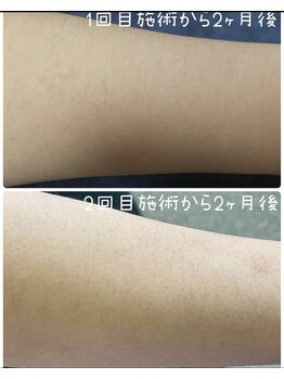 タグ シー(#She)/中学生腕beforeafter