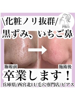 ビアス(Vias)/いちご鼻改善/黒ずみ/毛穴ケア