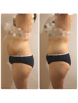 リボディ プラチナ(Rebody platinum)/脂肪冷却×ボディスカルプト