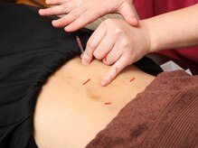 鍼灸整体院メグル 鷺沼院(鍼灸整体院meguru)/鍼灸施術（1）