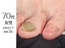 フットケア クラッシー(footcare classy)/お悩みケア