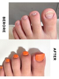 【美爪育成】《フット》深爪改善