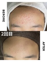 ゼロ 水戸店(ZERO)/シミ・シワ改善スペシャル300