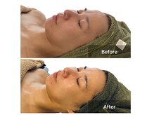 ベンザイ 新潟店(BENZAI)/小顔/リフトアップ/1回で満足◎