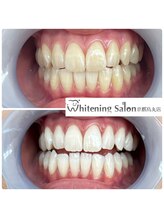 ホワイトニングサロン 京都烏丸店/ホワイトニング施術例