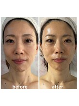 ウィッシュプロサロンケー(WISHpro salon K)/インディバフェイシャル1回