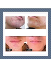 ディアレスト(Dearest)/メンズ 顔 脱毛