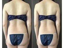 バーテックスキー(Vertexkey)/ハイパーナイフ サイズダウン