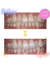 エクシアホワイト 新宿御苑店(ecxia white)/ホワイトニングビフォーアフター