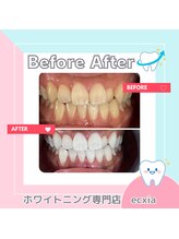 エクシアホワイトニング 札幌中島公園店/BeforeAfter［ホワイトニング］ 