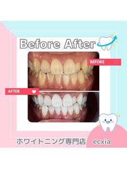 エクシアホワイトニング 札幌中島公園店/BeforeAfter［ホワイトニング］ 