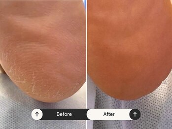 パッソ(Passo)/ケアを怠るとすぐにカサカサに