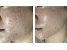 リボーン(REBORN)/繰り返すニキビケアに！