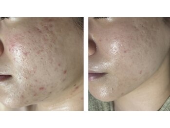 リボーン(REBORN)/繰り返すニキビケアに！