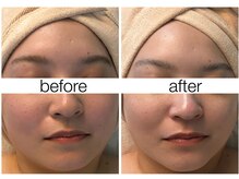 ハリスキンラボ(Hari.Skin.Lab)/30代のお客様/1回の施術効果