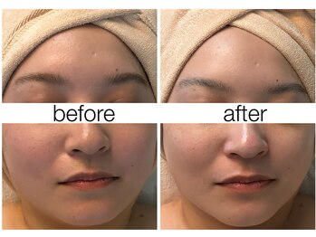 ハリスキンラボ(Hari.Skin.Lab)/30代のお客様/1回の施術効果
