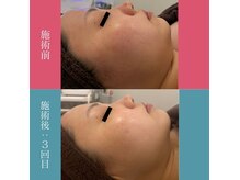 脂肪分解剤レモンボトルで小顔♪ハイドロ後に導入で肌改善まで◎