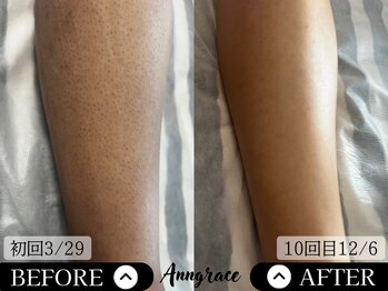 アングレイス(Anngrace)/【全身脱毛あし】Before/After