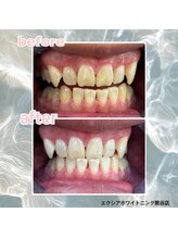 エクシアホワイトニング 熊谷店/歯のビフォーアフター