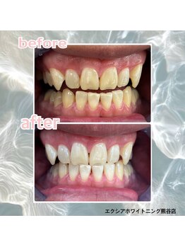 エクシアホワイトニング 熊谷店/歯のビフォーアフター