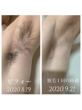 リアンジュ/脇脱毛