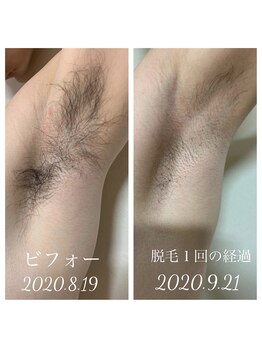 リアンジュ/脇脱毛