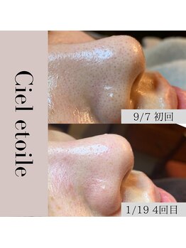 シエルエトワレ/毛穴エクストラクション