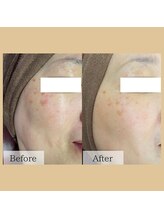 チャイディー(Chai Dee)/大人気の光フェイシャル！