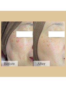 チャイディー(Chai Dee)/大人気の光フェイシャル!