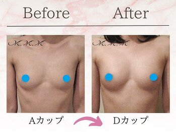 エムエムエム 表参道Luxeサロン(M.M.M)/【バストアップ例】　A→Dカップ