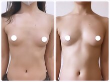 プリマ(prima)/バストアップ症例
