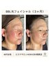 【小顔＋美肌】マイナス10歳肌＋AI 肌診断（皮下シミ撮影）¥11,000→¥5,000