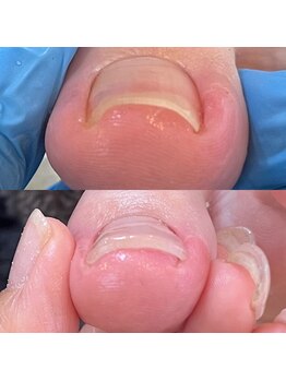 ウェルズユキ(well's yuki)/巻き爪 変形爪 肥厚爪