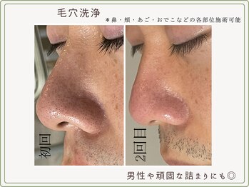 べセラ(BESERA)/毛穴洗浄 2