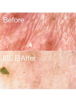 ミニョスキンラボ/韓国式ハーブピーリング6回