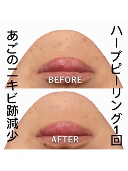 スピード美人 新宿店/ハーブピーリング顔1回