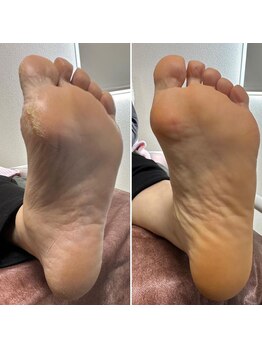 ネイルズクレア(Nail's Crea)の写真/美容大国韓国で大人気♪フットケアも当店にお任せ！気になるニオイや角質を除去し、ツルツルの素足美人に！