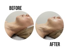 イードット(E.)/大人気！光BBLフェイシャル！