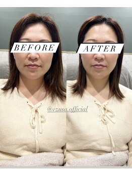 シロ(silo.)/美顔器と耳つぼ　before after